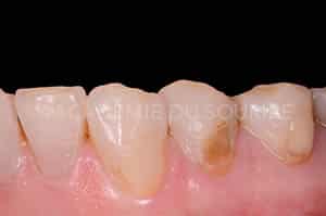 Préservation gingivale