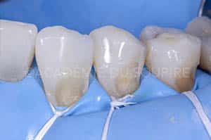 Préservation gingivale