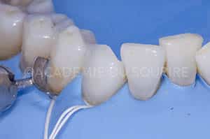 Préservation gingivale