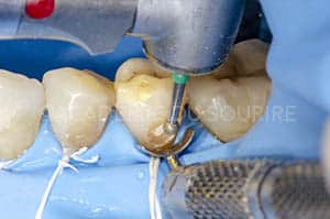Préservation gingivale