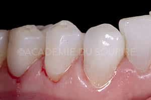 Préservation gingivale