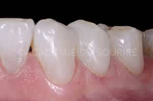 Préservation gingivale