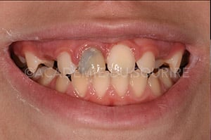 masquer discoloration dentaire résine composite