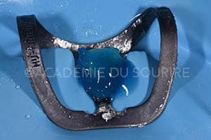 masquer discoloration dentaire résine composite