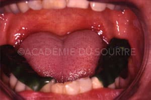 Déprogrammation TENS dentaire