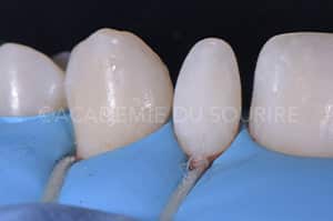 composite injecté clé silicone