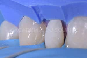 composite injecté clé silicone