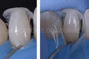 composite injecté clé guide silicone
