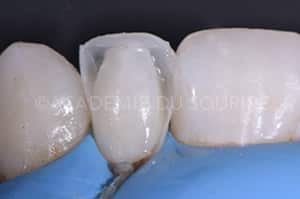 composite injecté clé silicone
