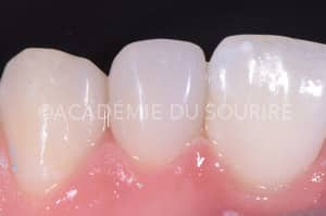 composite injecté clé silicone