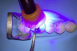 Stamp technique dent
