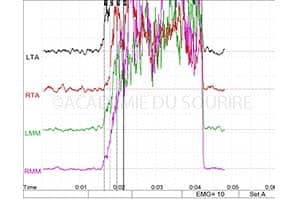 correction occlusale hémi orthèse