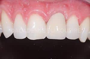 provisoire dentaire communication laboratoire