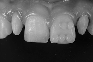 Relevé de couleur dentaire technique bouton
