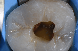 Obturation overlay endodontique