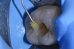 Obturation overlay endodontique