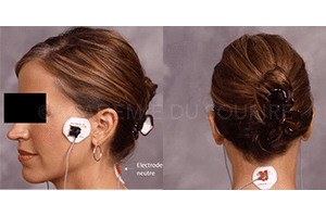 TENS neuromusculaire occlusion dentaire déconditionnement muscules manducateurs