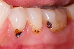 Caries cervicales