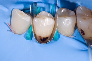 Caries cervicales