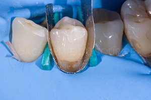 Caries cervicales