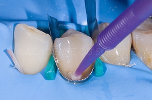 Caries cervicales