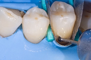 Caries cervicales