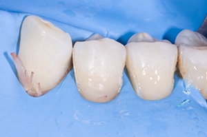Caries cervicales