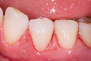Caries cervicales