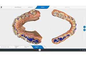 Enregistrement numérique occlusion statique