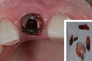 Extraction implant dentaire
