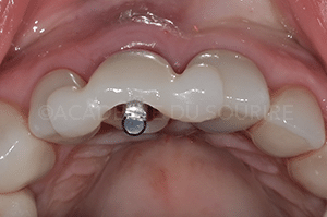 Extraction implant dentaire
