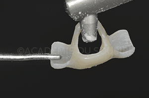 Extraction implant dentaire