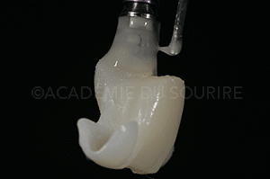 Extraction implant dentaire