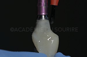 Extraction implant dentaire