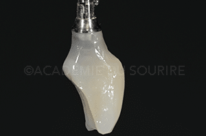 Extraction implant dentaire