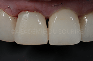 Extraction implant dentaire