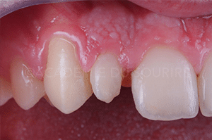 reproduire taches fluorose dent provisoire