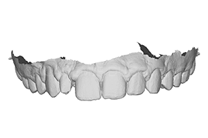 reproduire taches fluorose dent provisoire
