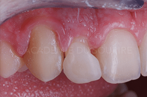 reproduire taches fluorose dent provisoire