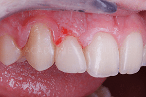 reproduire taches fluorose dent provisoire