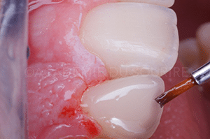 reproduire taches fluorose dent provisoire