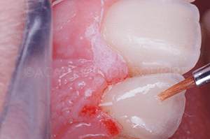 reproduire taches fluorose dent provisoire