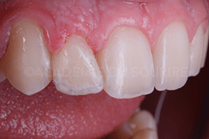 reproduire taches fluorose dent provisoire