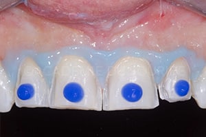 Temporisation facettes