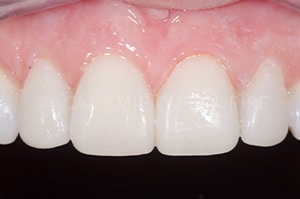 Temporisation facettes