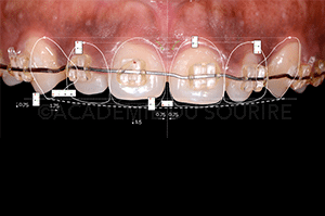 Gingivoplastie