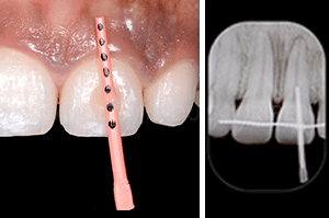 Gingivoplastie