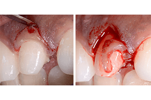 Gingivoplastie