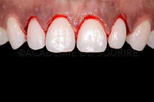 Gingivoplastie