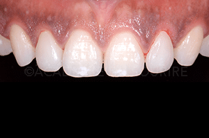 Gingivoplastie